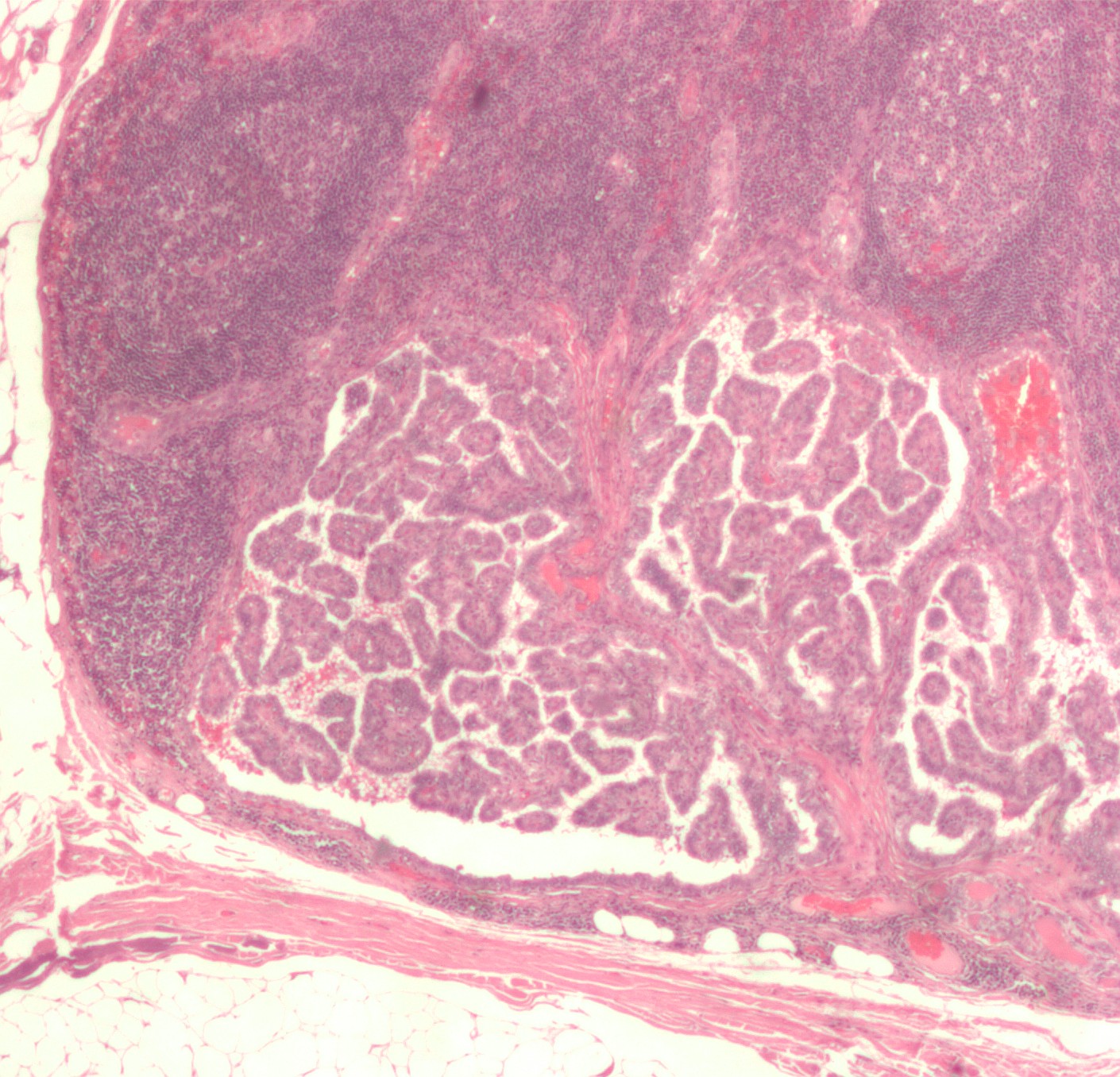 A low-power histology section showing metastatic papillary thyroid carcinoma replacing part of a lymph node, illustrating differentiated thyroid cancer and structural nodal disease.
