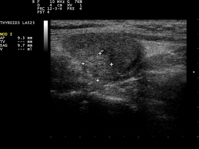 A thyroid ultrasound showing a hypoechoic nodule that is taller than wide with microcalcification and an irregular margin; use as a visual prompt for suspicious features, while the current local ultrasound grading system and clinical context determine whether FNAC is indicated.
