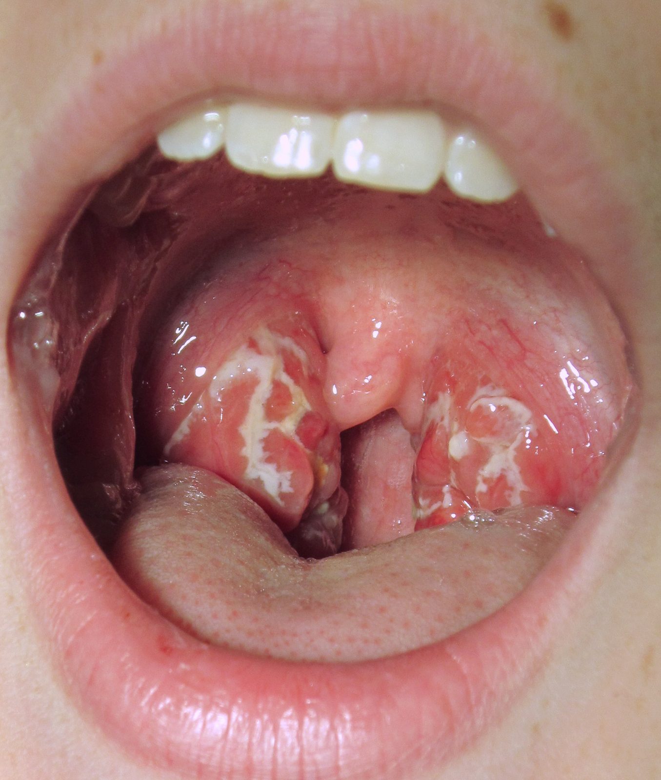 Enlarged tonsils with white exudate in acute exudative tonsillitis; exudate is not by itself proof of bacterial infection.