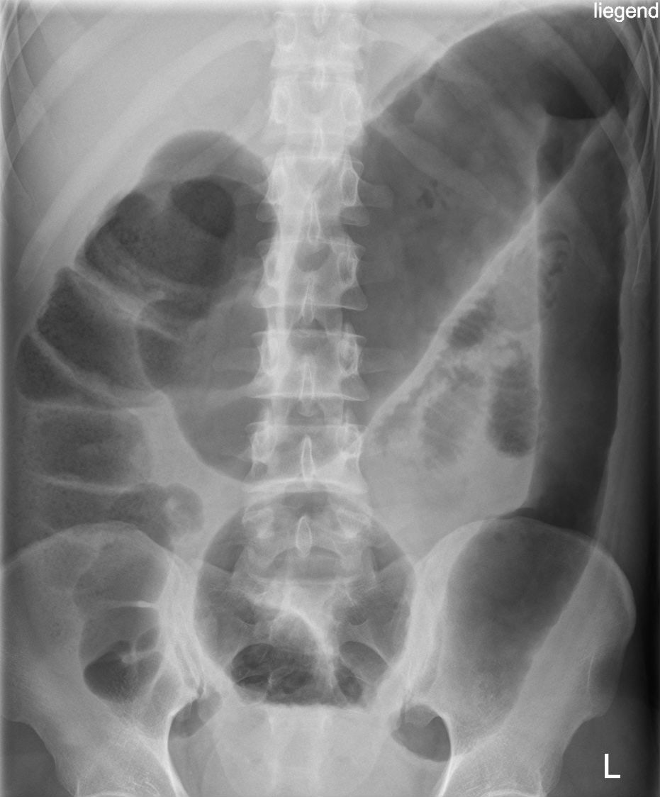 A plain abdominal radiograph showing marked non-obstructive colonic dilatation in severe colitis, with the dilated segment and measurement site labelled and a warning that systemic toxicity is required for the syndrome diagnosis.