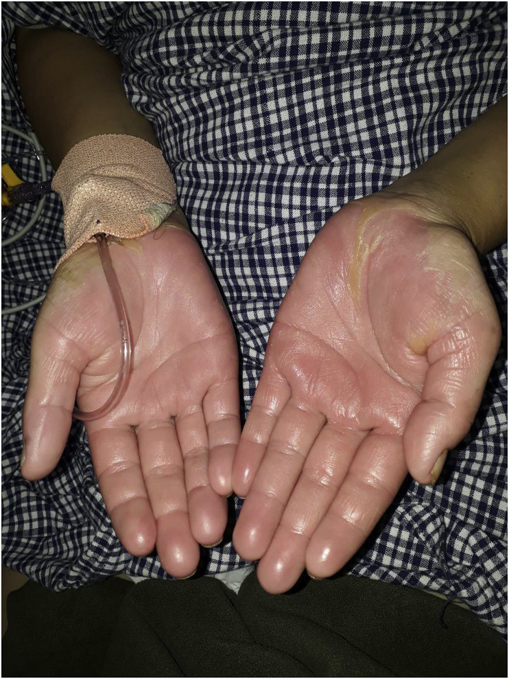 Clinical photograph showing bilateral palmar desquamation during recovery from toxic shock syndrome.