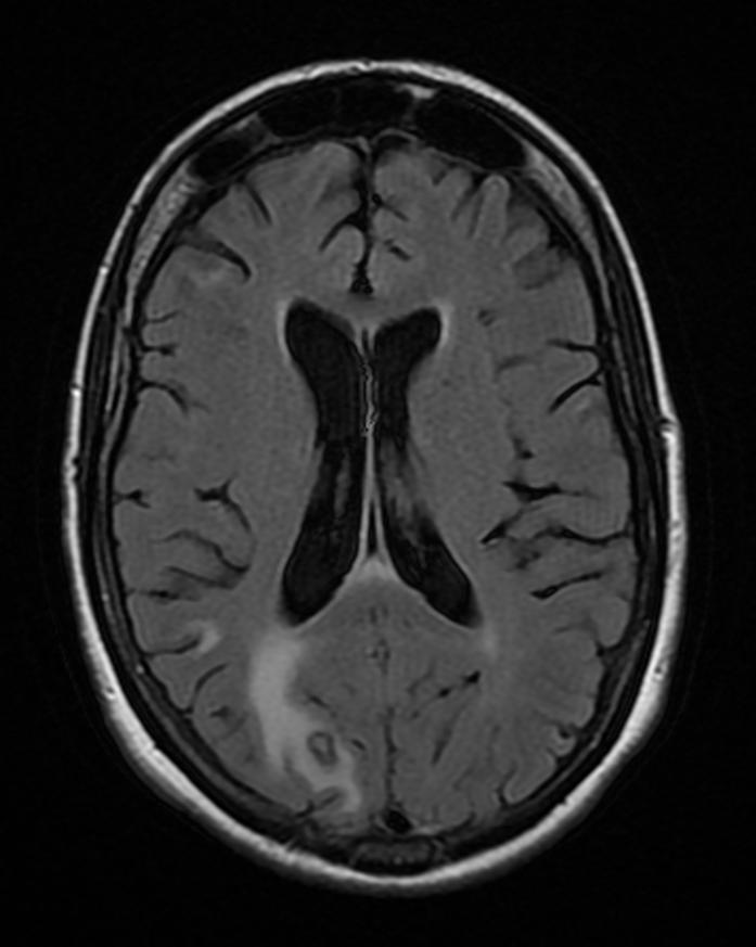 Axial brain MRI showing a ring-like right occipital lesion with surrounding oedema in cerebral toxoplasmosis in advanced HIV.