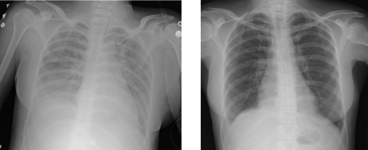 Paired chest radiographs showing diffuse bilateral air-space opacity during transfusion-related acute lung injury and subsequent clearing after recovery.