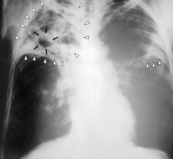 Chest radiograph showing upper-lobe cavitating consolidation in post-primary pulmonary tuberculosis; imaging is supportive and requires microbiological correlation.