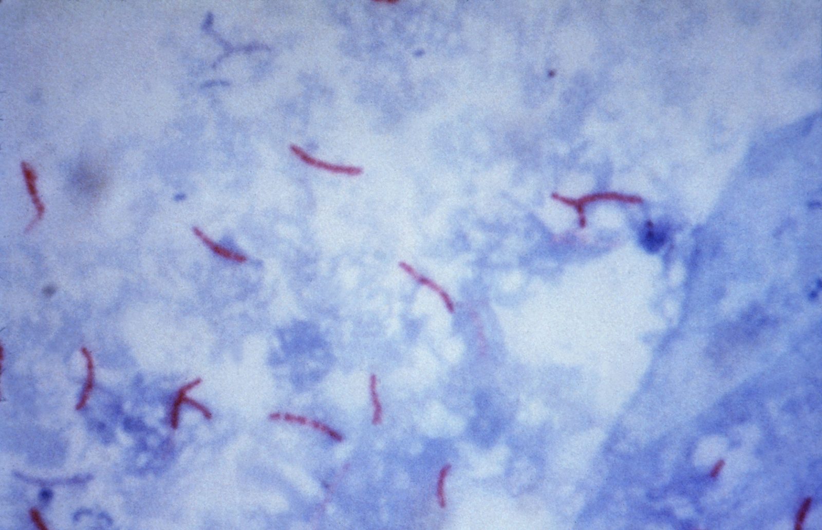 Microscopy image showing red-staining acid-fast bacilli against a blue counterstain; smear sensitivity is limited and culture or molecular testing is still needed.