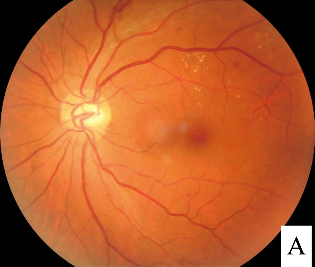 Retinal photograph showing microaneurysms, dot-and-blot haemorrhages and exudates of background diabetic retinopathy.