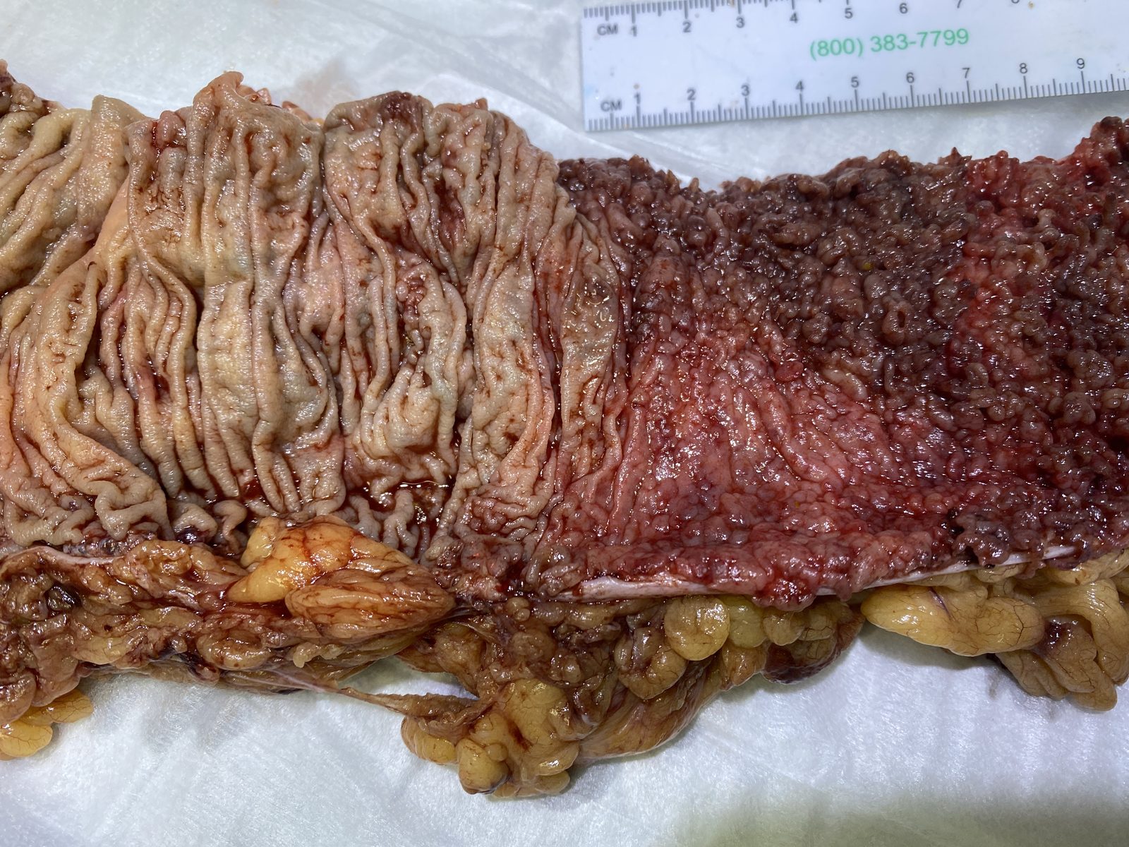 Opened colectomy specimen showing confluent mucosal inflammation with a sharp transition to less affected mucosa, illustrating the continuous colonic distribution of ulcerative colitis.
