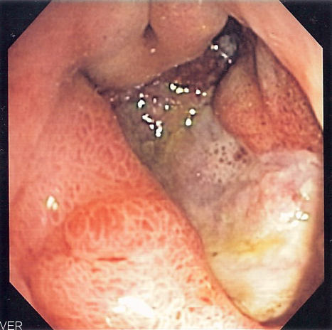 Endoscopic view of a deep gastric ulcer, the commonest non-variceal source of acute upper gastrointestinal bleeding.