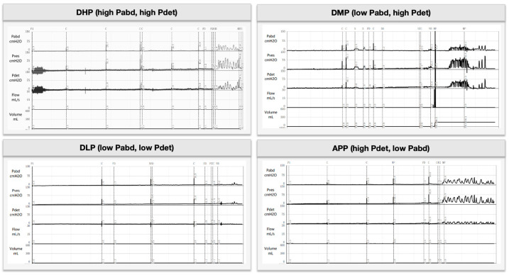 Representative urodynamic traces plotting abdominal, vesical and calculated detrusor pressure alongside urinary flow and volume, measurements used to distinguish mechanisms contributing to urinary incontinence and voiding dysfunction.
