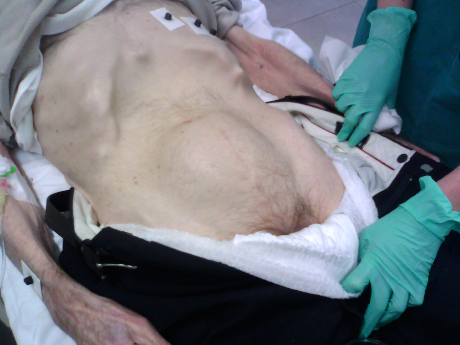 Clinical photograph showing a large smooth suprapubic swelling caused by a markedly distended bladder in urinary retention.