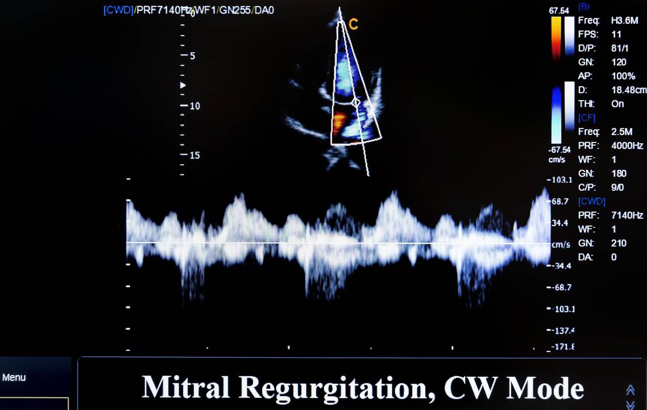 Continuous-wave Doppler recording through a mitral regurgitation jet, with a colour Doppler inset, illustrating a regurgitant valve lesion that produces left-sided volume overload.