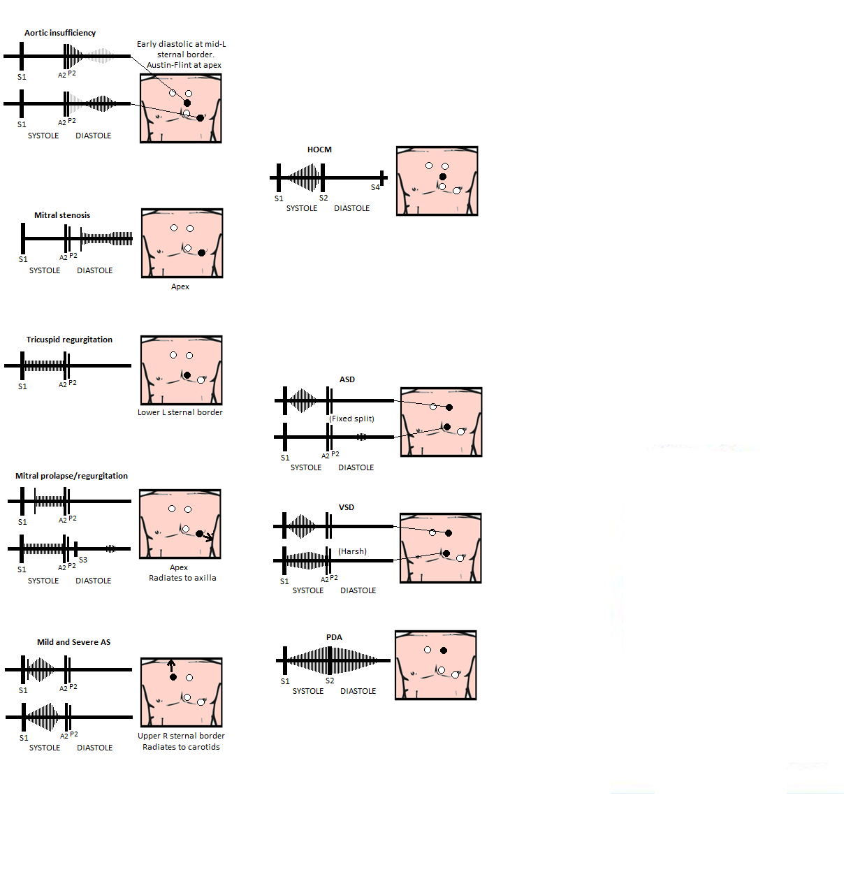 Diagram mapping each valve lesion to its murmur timing (systolic or diastolic), auscultation site and radiation: aortic stenosis, aortic regurgitation, mitral stenosis and mitral regurgitation.