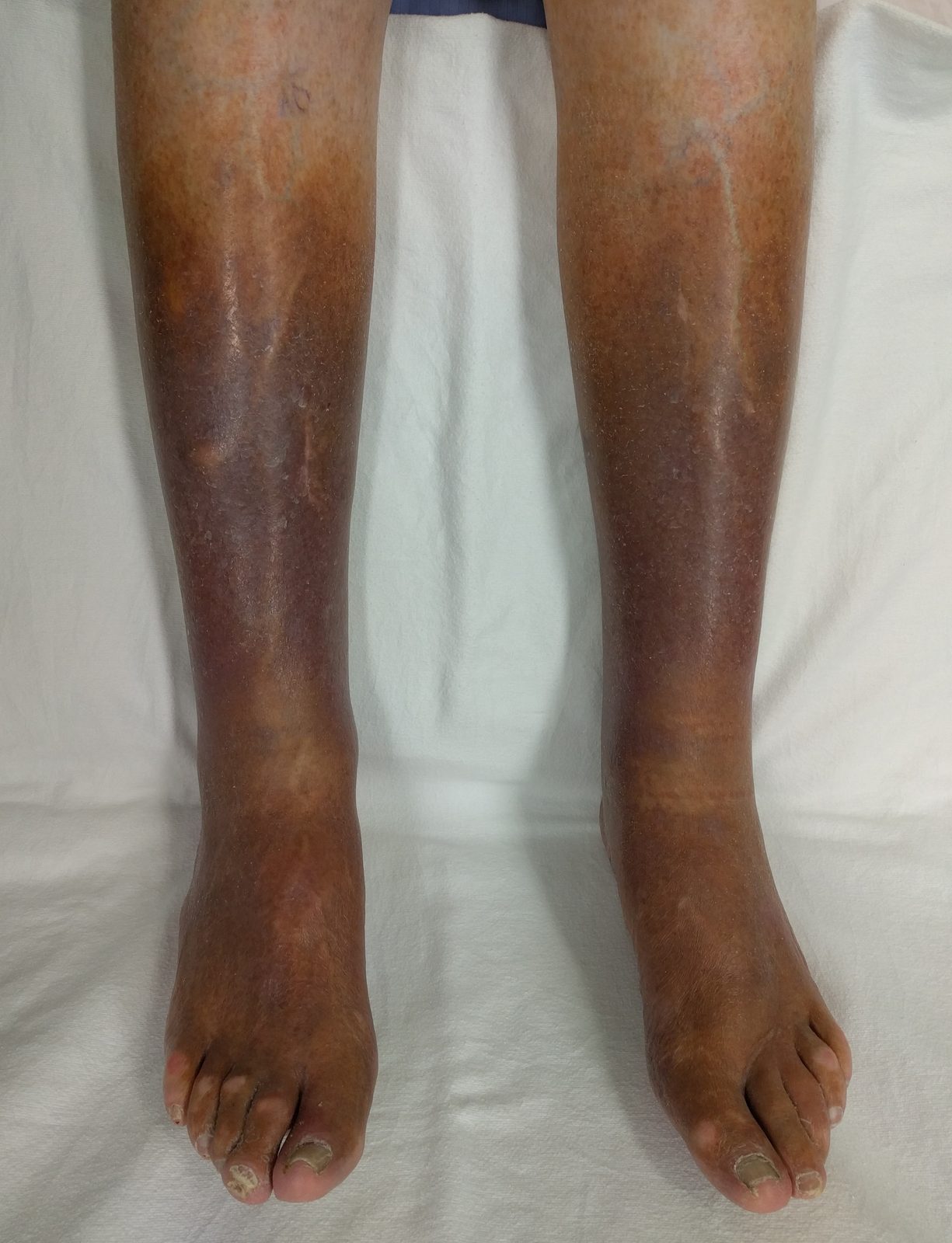 Leg photograph showing dilated tortuous superficial veins alongside haemosiderin pigmentation and lipodermatosclerosis.