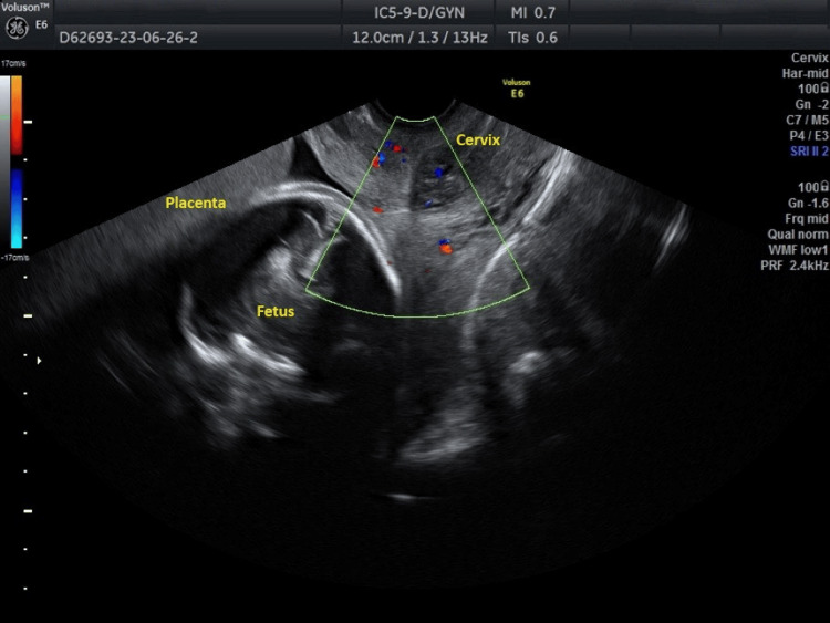 Transvaginal colour Doppler showing fetal blood flow close to the internal cervical os, the key antenatal finding in vasa praevia.