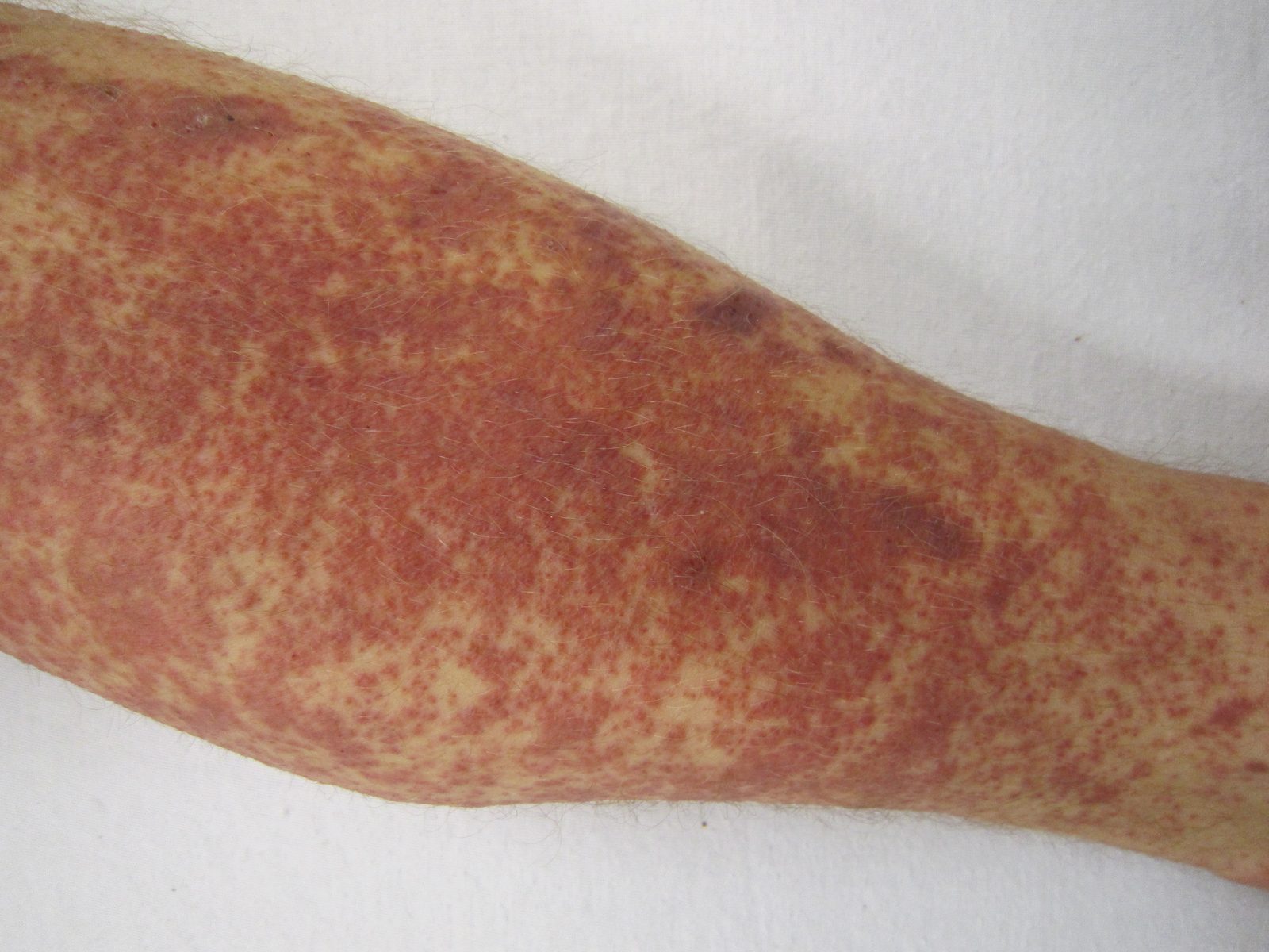 A clinical photograph of palpable purpura on the lower legs, with accessible colour and skin-tone context. Do not imply that all vasculitis is cutaneous.