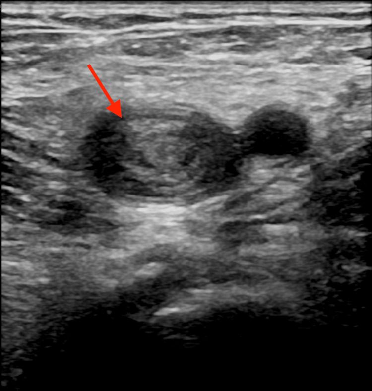 Compression ultrasound showing a non-compressible left common femoral vein containing thrombus, illustrating the key finding in suspected pregnancy-associated DVT.