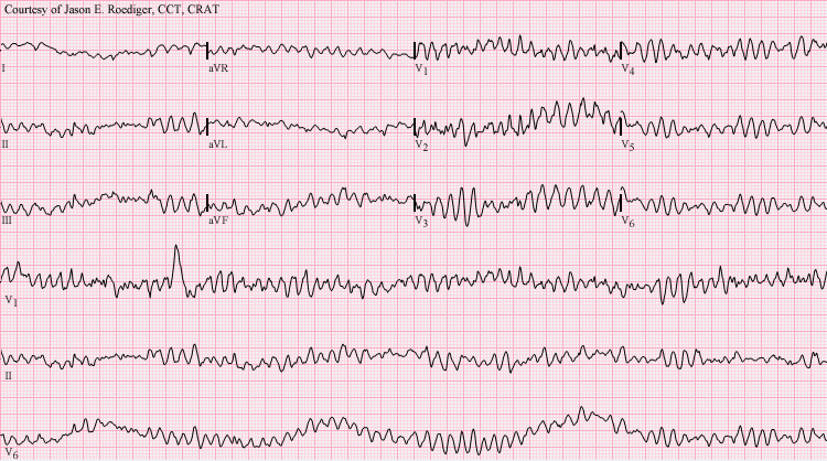 Chaotic ventricular activity of varying amplitude with no consistent organised QRS complexes. In clinical practice, VF is identified on the attached defibrillator during cardiac arrest; a diagnostic 12-lead ECG must never delay the first shock.