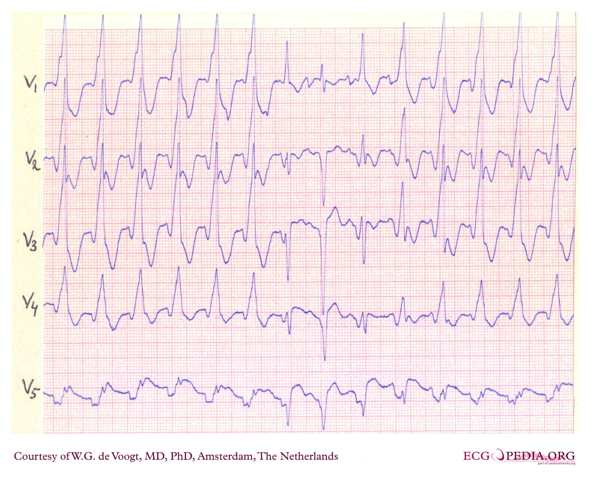 A predominantly regular broad-complex tachycardia with similar QRS morphology from beat to beat. Intermittent narrower or intermediate complexes may represent capture or fusion beats and support ventricular origin, but treatment must be driven first by pulse and haemodynamic state.