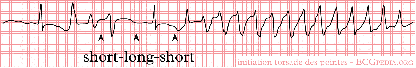A rhythm strip showing a short-long-short ventricular sequence preceding the onset of polymorphic ventricular tachycardia. Torsades is the long-QT subtype; confirm QT prolongation on surrounding sinus-rhythm ECGs and review medicines and electrolytes.