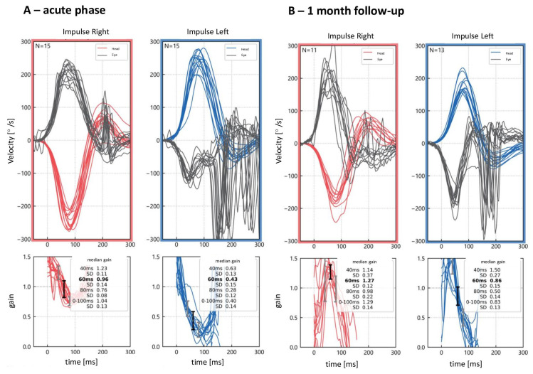 Video head-impulse testing showing reduced vestibulo-ocular reflex gain and corrective saccades during leftward impulses in unilateral peripheral vestibular loss. HINTS interpretation requires a trained examiner and the correct acute vestibular syndrome context.