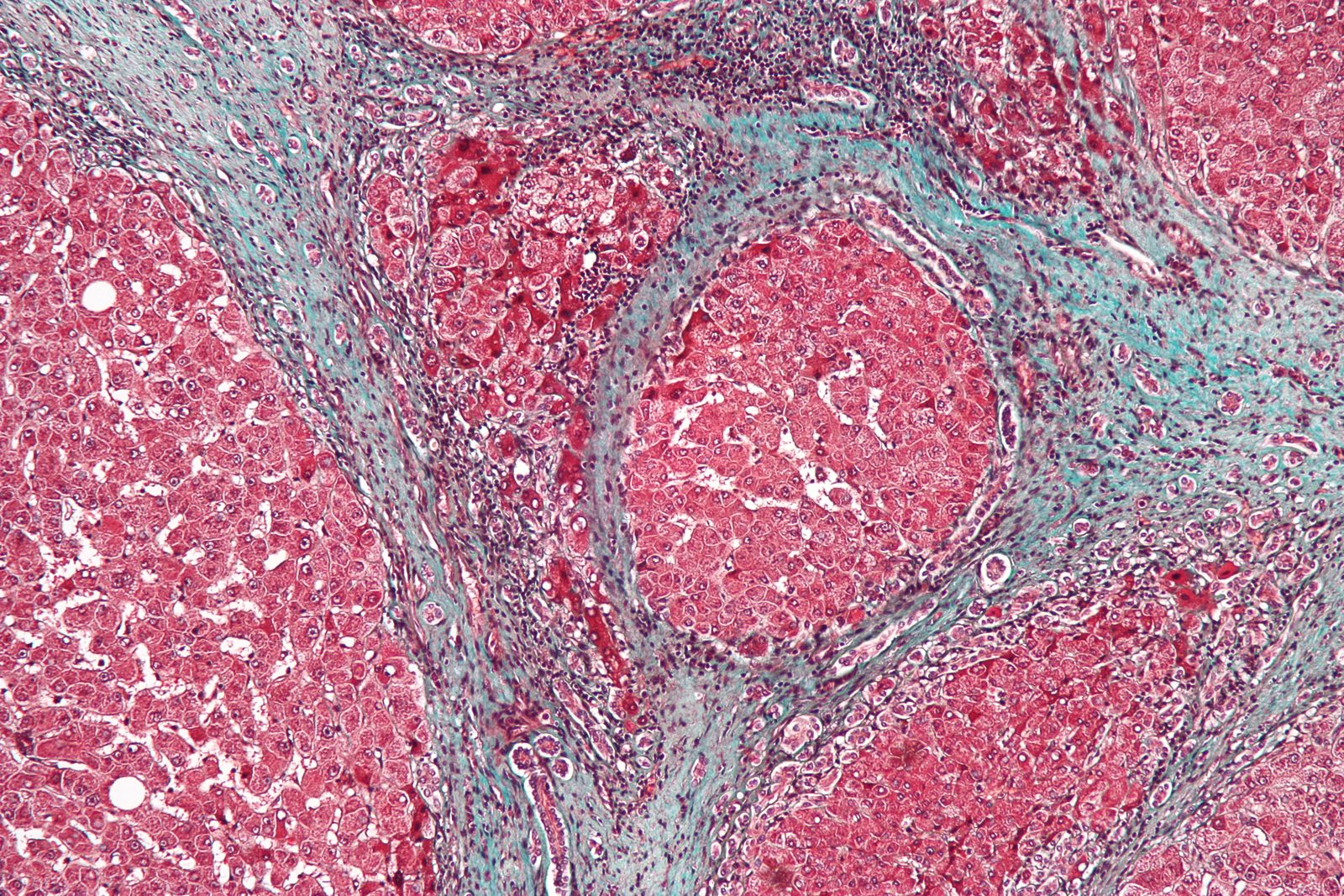 Trichrome-stained liver showing broad fibrous septa surrounding regenerative nodules, illustrating the architectural distortion that follows chronic viral hepatitis.