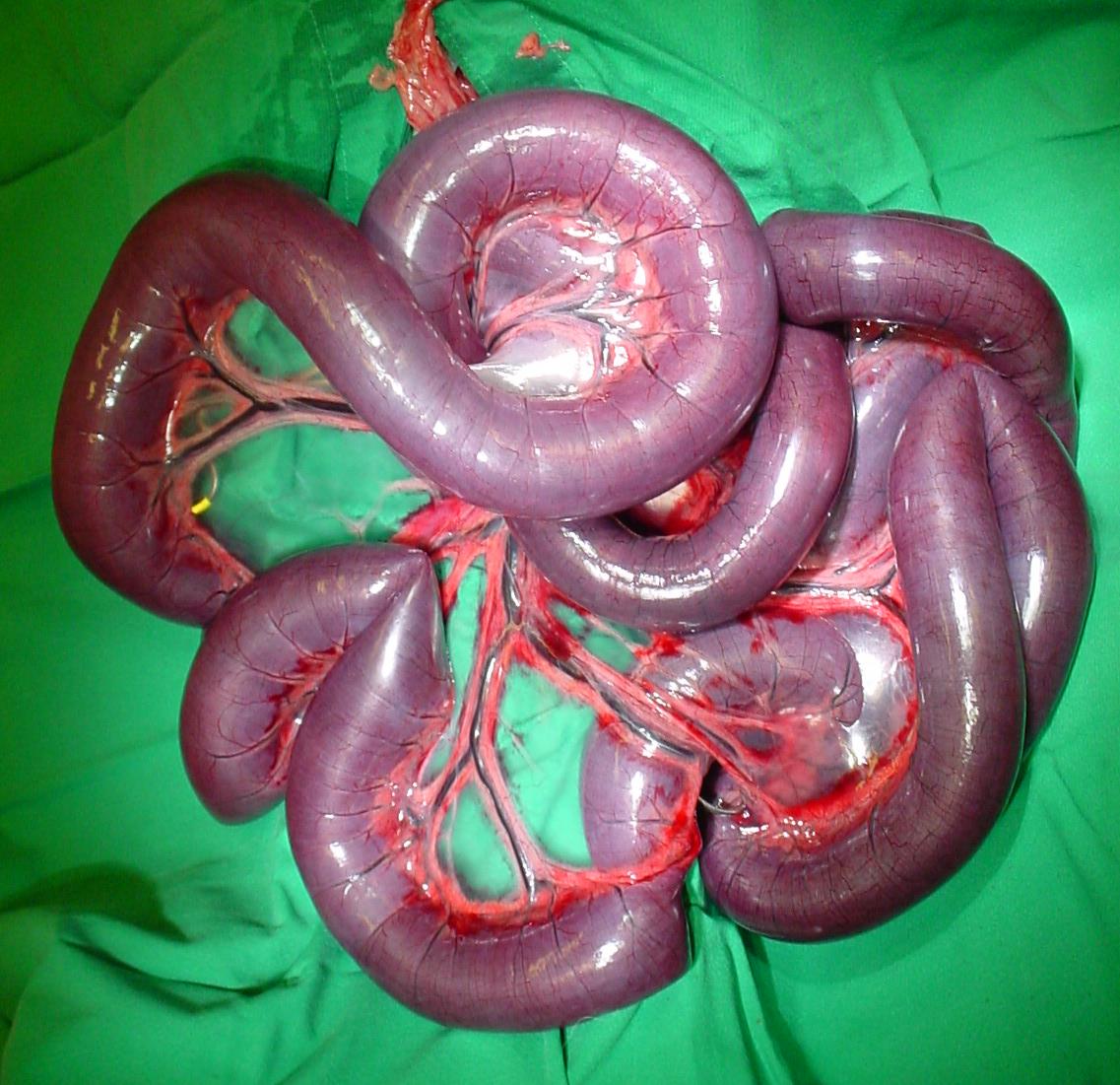 Markedly distended, congested loops of bowel with a twisted mesenteric pedicle at laparotomy, illustrating closed-loop obstruction and threatened or established ischaemia.