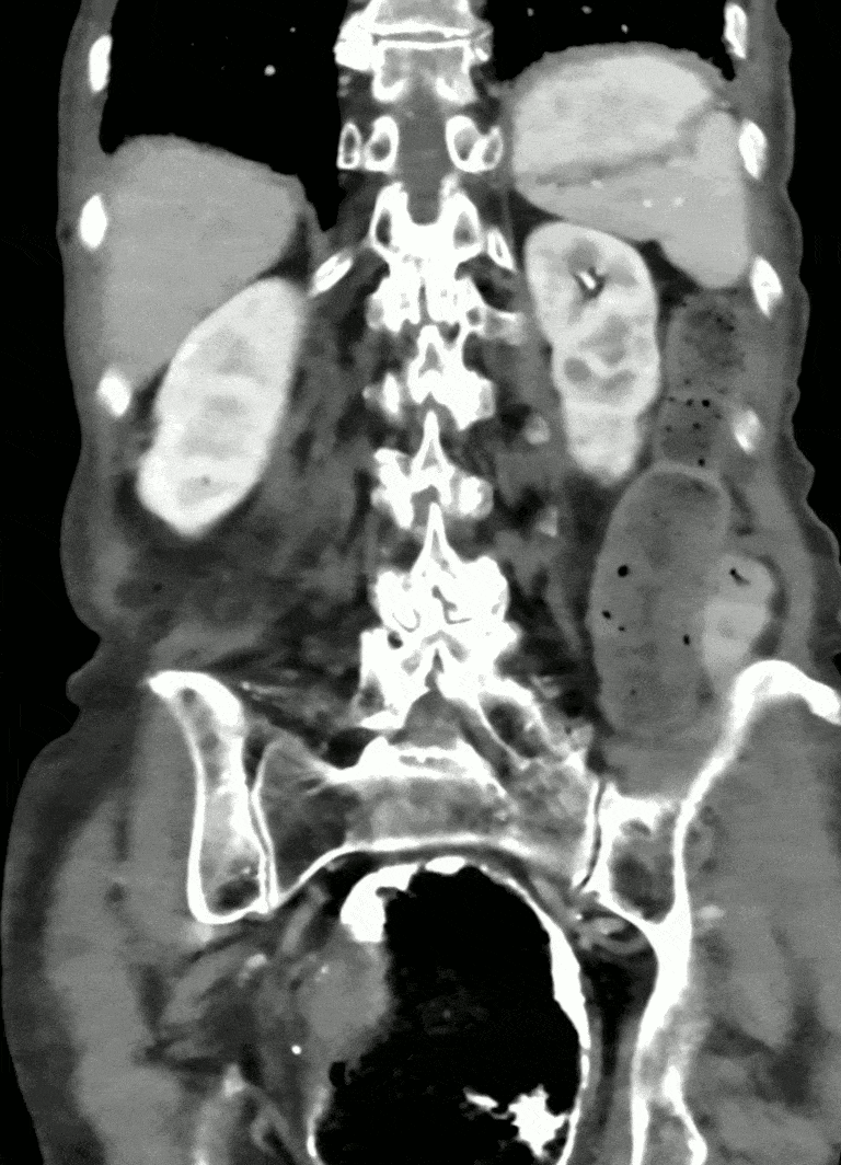 A diagram of a bowel loop twisted around its mesenteric axis, occluding both the lumen and mesenteric vessels, with the CT whirl sign labelled.