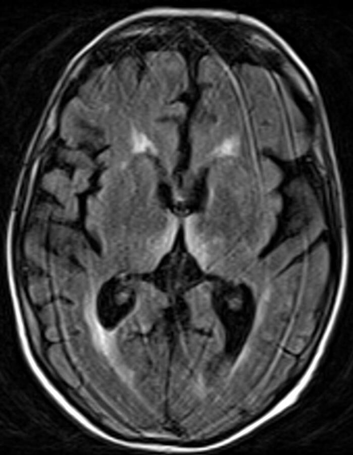 Axial FLAIR brain MRI showing symmetric hyperintense signal in the medial thalami, with a caption emphasising that MRI can support but never exclude the diagnosis and must not delay parenteral thiamine.