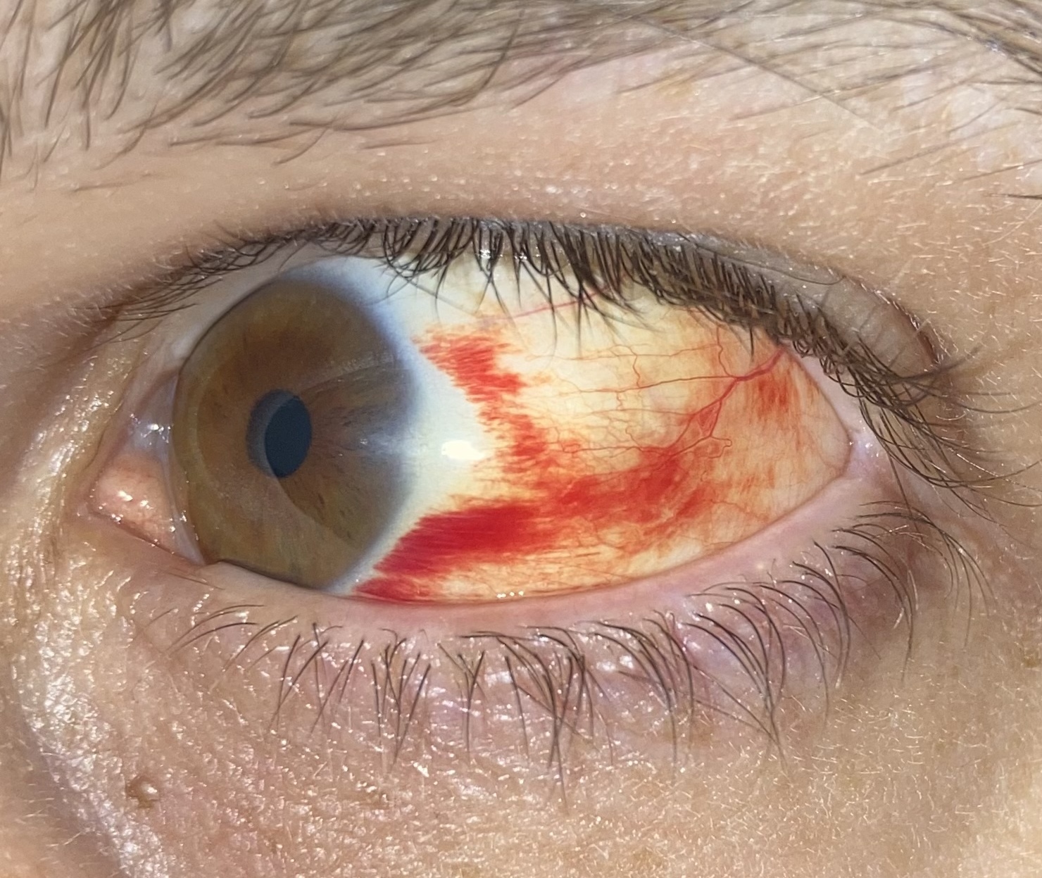 A sharply demarcated bright-red subconjunctival haemorrhage beneath the bulbar conjunctiva, shown as a possible consequence of forceful coughing rather than a diagnostic feature.